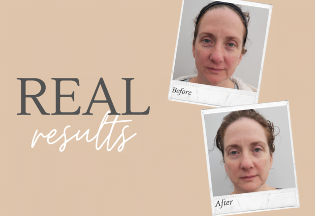 Real Results, Real People, Sensitive Skin